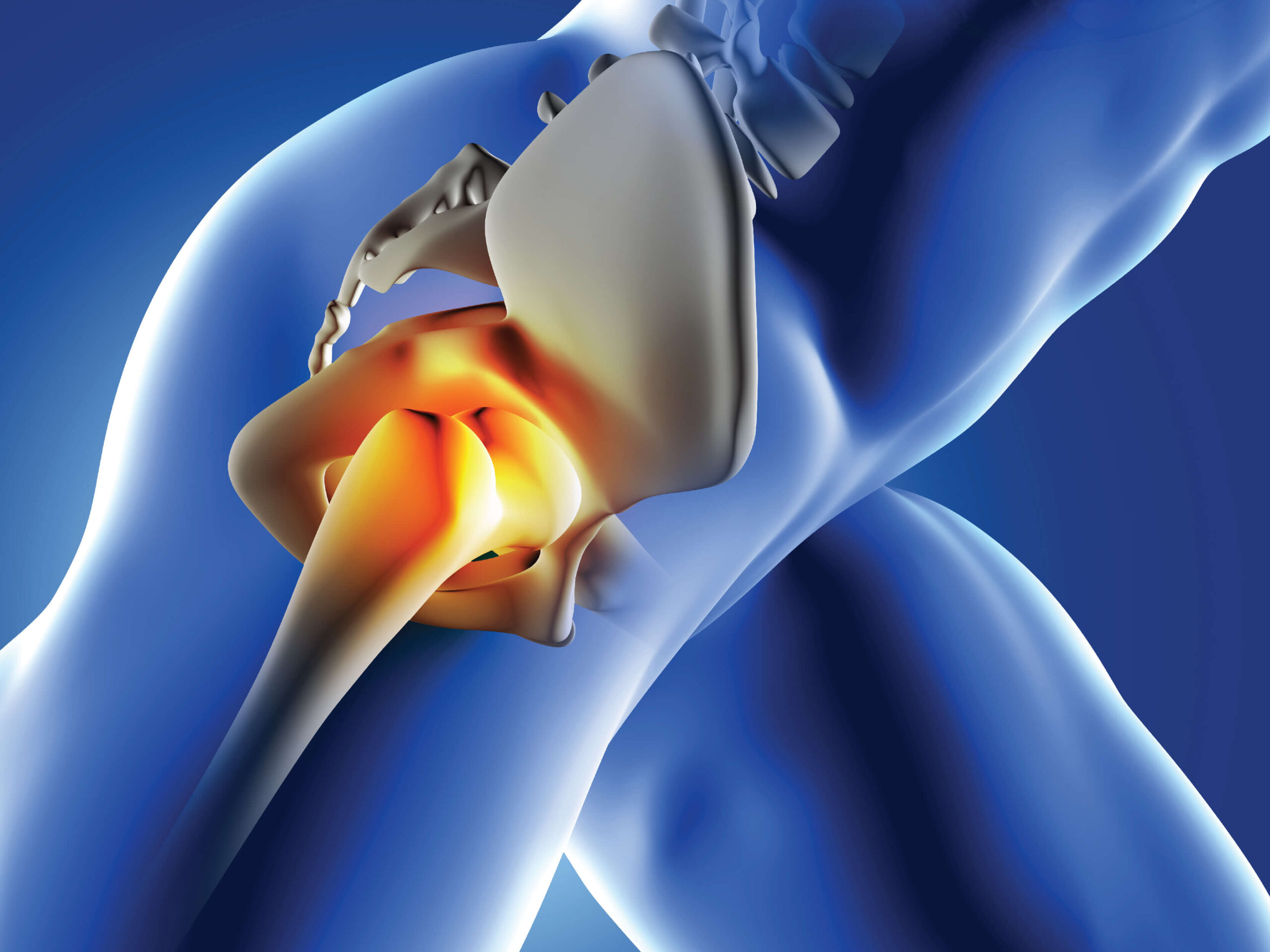 Hip Replacement Surgery