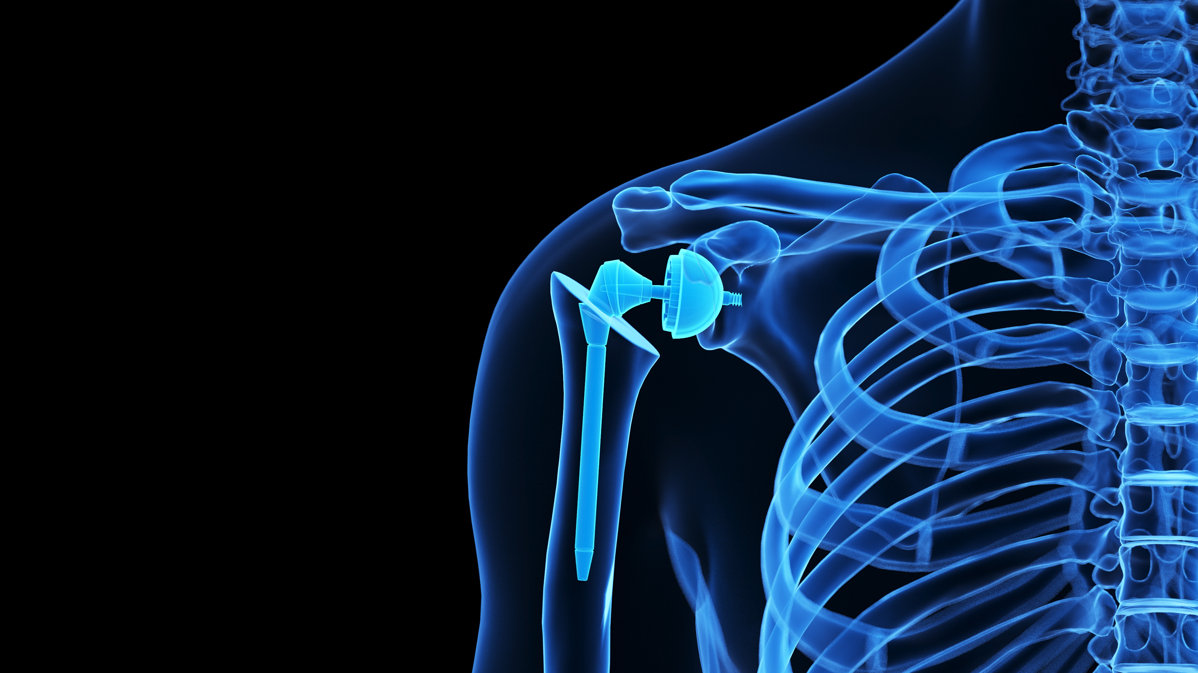 Shoulder Joint Replacement
